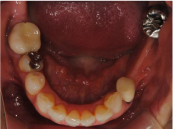 インプラント画像2-1