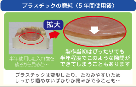 プラスチックの磨耗